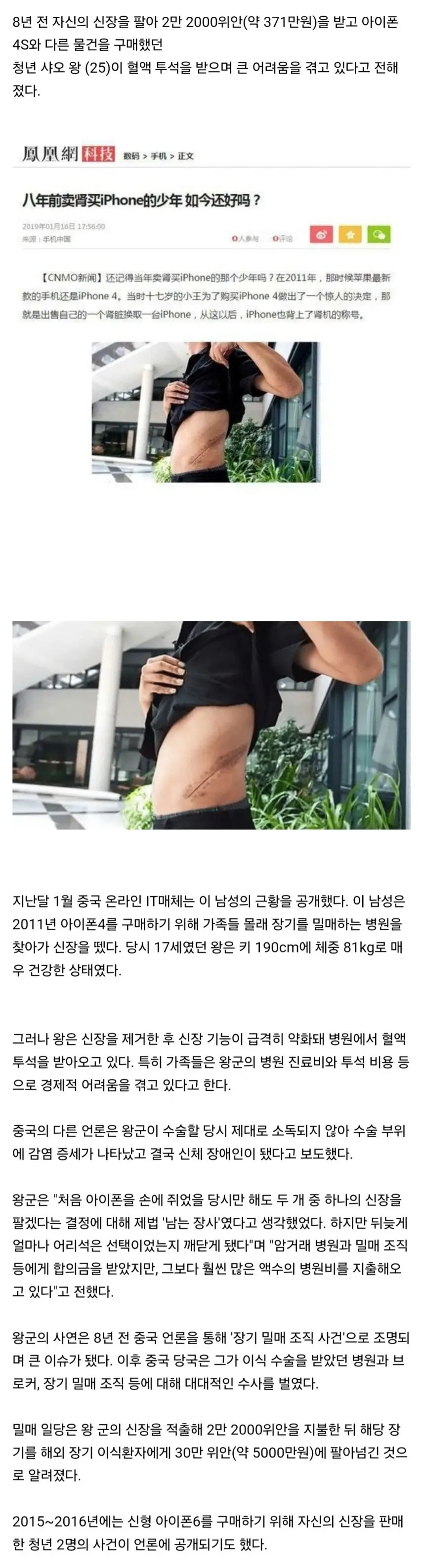 신장 팔아서 370만원 받아 아이폰 산 청년의 뒤늦은 후회